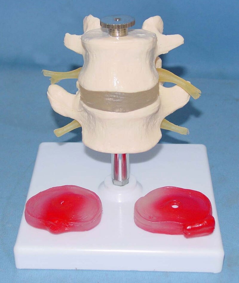 Duas Se Es Da Doen A De Disco Lombar H Rnia De Disco Modelo Umbar De Doen A Do Disco