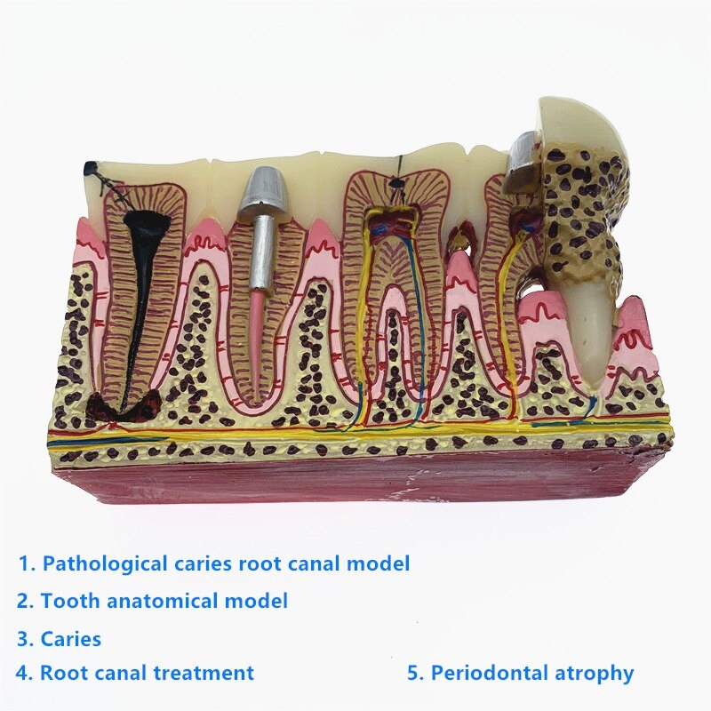 Dental Caries Tooth Model common pathologies model... – Vicedeal