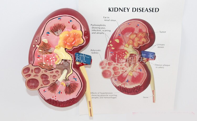 Nierziekte model urologie nier nephron renale glomerulus nier anatomisch model