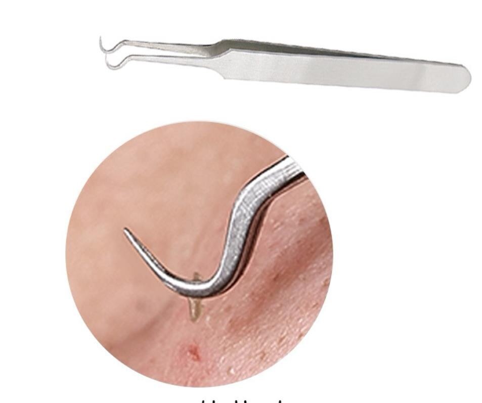 3Pcs Stainless Blackhead Facial Acne Spot Pimple Remover Extractor Tool Comedone Set