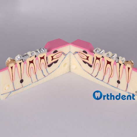 Dental Disease Teeth Anatomy Study Model Molar Cross Section Model