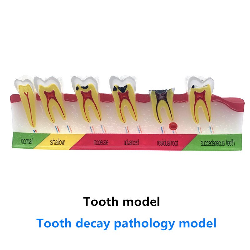 Dental caries classify model Tooth Model of pathol... – Vicedeal