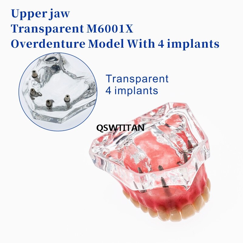 Sobredentadura Dental Superior con 4 implantes, modelo de demostración, enseñanza Dental, estudio, modelo de dientes