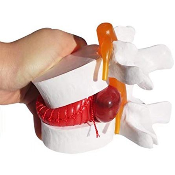 1pc Anatomical Lumbar Disc Herniation Lumbar Spine Model White Color J99Store