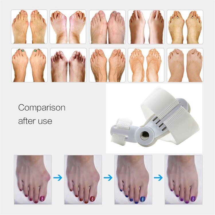 thumbnail image 2 of 2-Pack Big Toe Bunion Splint - Straightener Corrector For Hallux Valgus Pain Relief 2 of 3