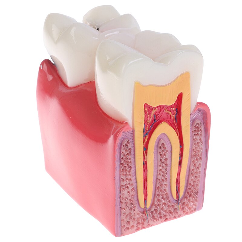 Dental Teeth Model 6 Times Caries Comparation Study Denture Tooth Models