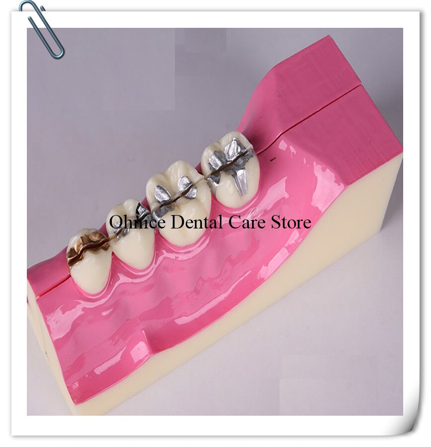 Periodontal disease teeth model M4009/dental teaching model Molar cross section study teeth model