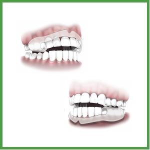 Silicone Mouth Guard Teeth Protector Night Guard Mouth Trays For Bruxism Grinding Anti-snoring Teeth Whitening Boxing Protection: Type1-2pcs