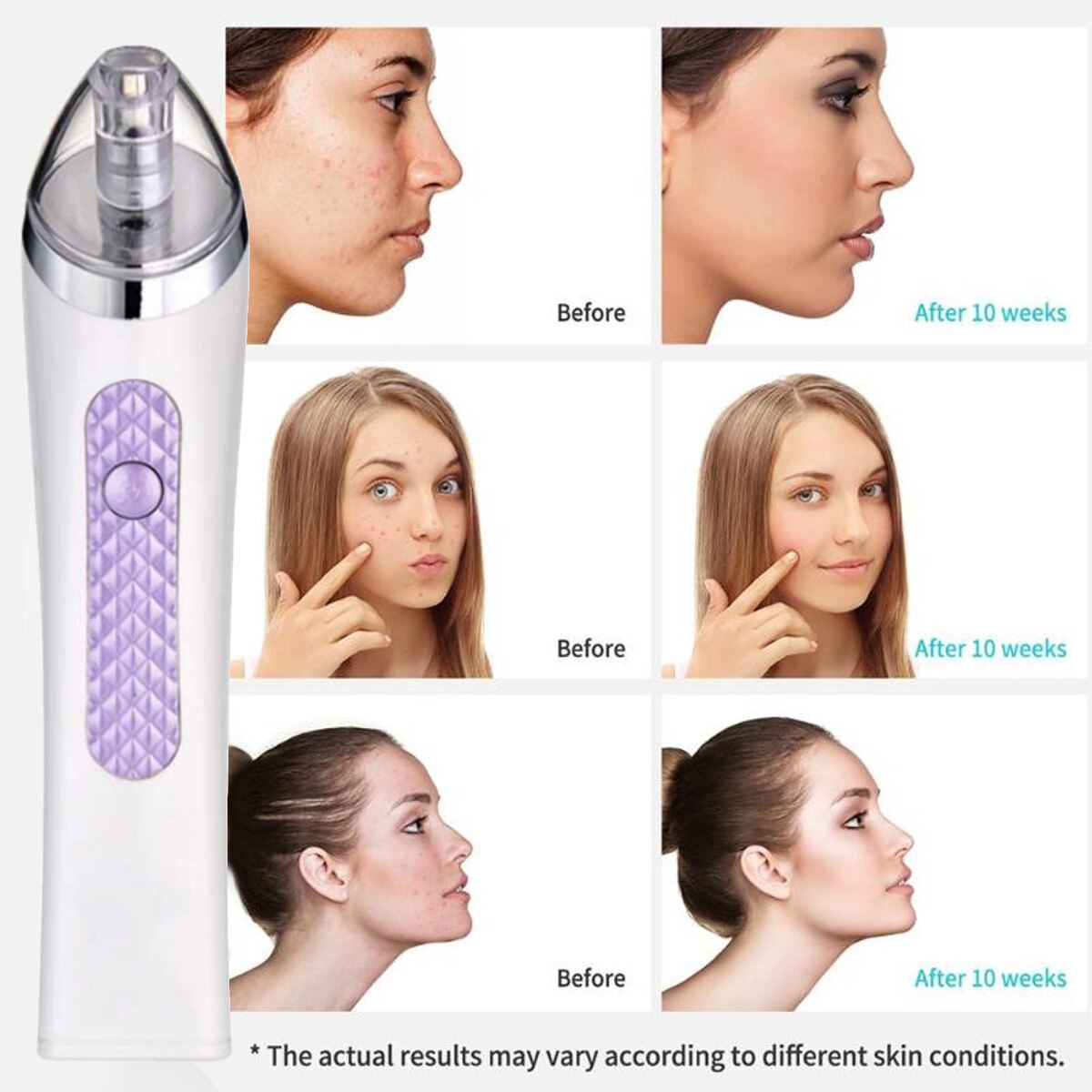 Face Acne Black Dot Pimple Blackhead Remover Electric Microcrystalline Blackhead Vacuum Cleaner Pore Blackhead Skin Care Machine