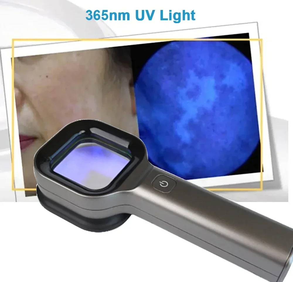 Woods Light Skin Examination For Cat Dog Ringworm Handheld UV Wood's lamp Skin Fungus Detector Vitiligo Pityriasis Versicolor