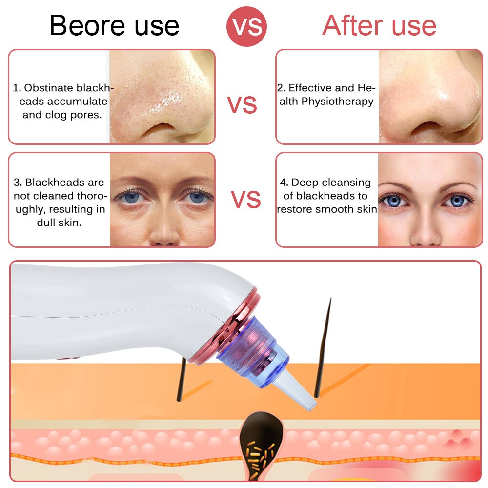 Microdermabrasion points noirs dissolvant visage peau aspirateur pores aspirateur acné bouton enlèvement outil + Mini Nano Facial vapeur
