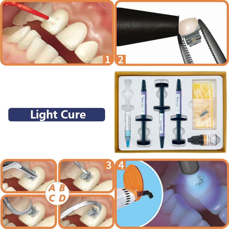 Adhesivo de ortodoncia Dental, Kit de pegamento de curado automático/ligero para soportes de ortodoncia, pegamento azul, sistema de unión directa de odontología