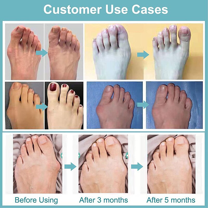 Pexmen 2 Teile/para Gel Zehe Separator Ballen Knochen Ektropium Erzähler Zehen Außen Gerät Fuß Pflege Werkzeuge Hallux Valgus Korrektor