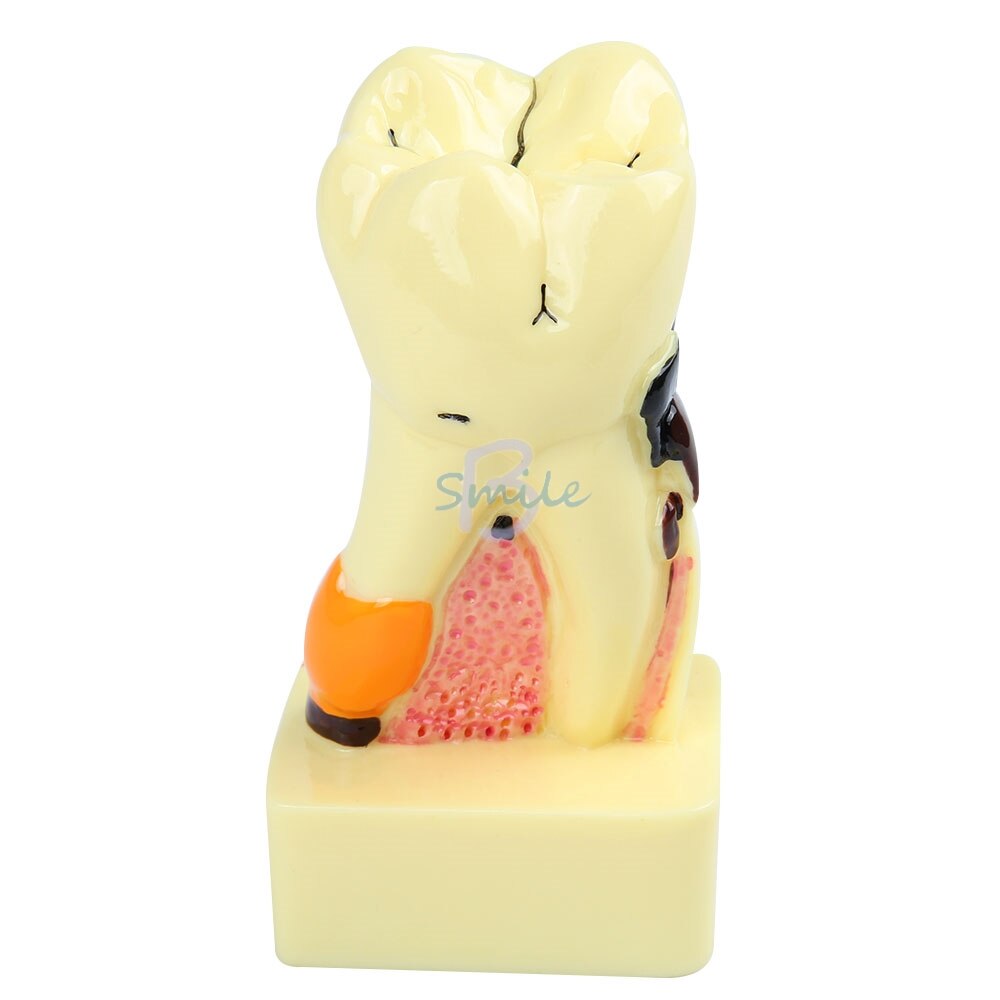 1pcs Dental Tooth Neuroanatomy Teaching Model 4 times transparent molar profile model with nerve Pathological Tooth Model