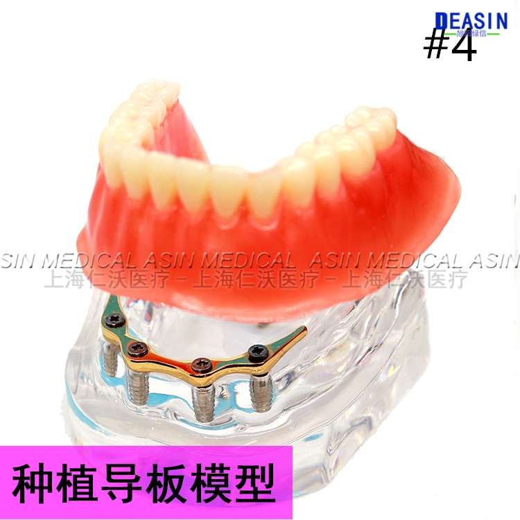 1 pc x Resin Coverage dental implant model dentures Removable teeth model for dentist study Deasin