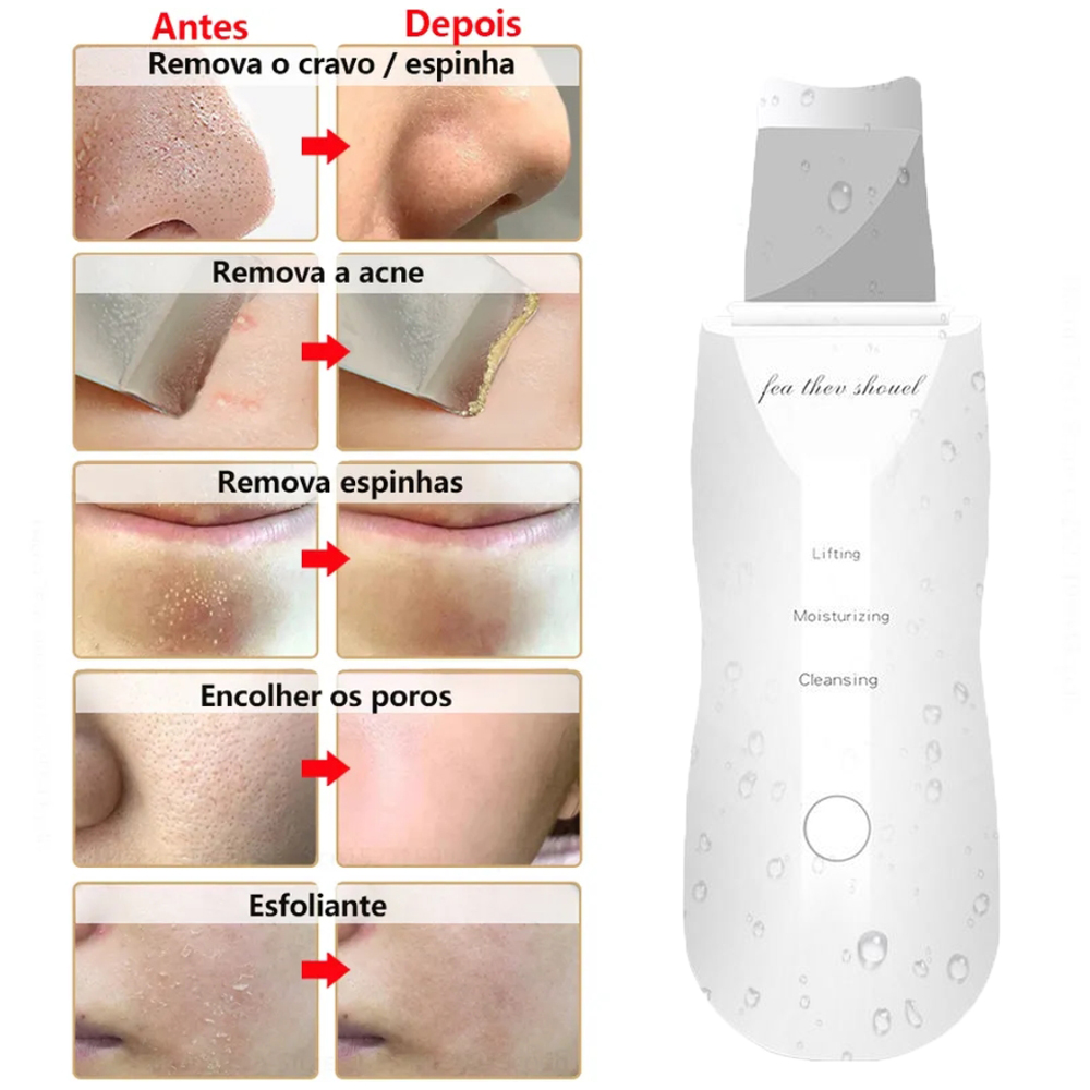 Removedor de espinillas, espátula de limpieza Facial profunda, máquina de elevación de limpieza Facial, pala exfoliante, limpiador de poros, eliminador de sebo de puntos negros
