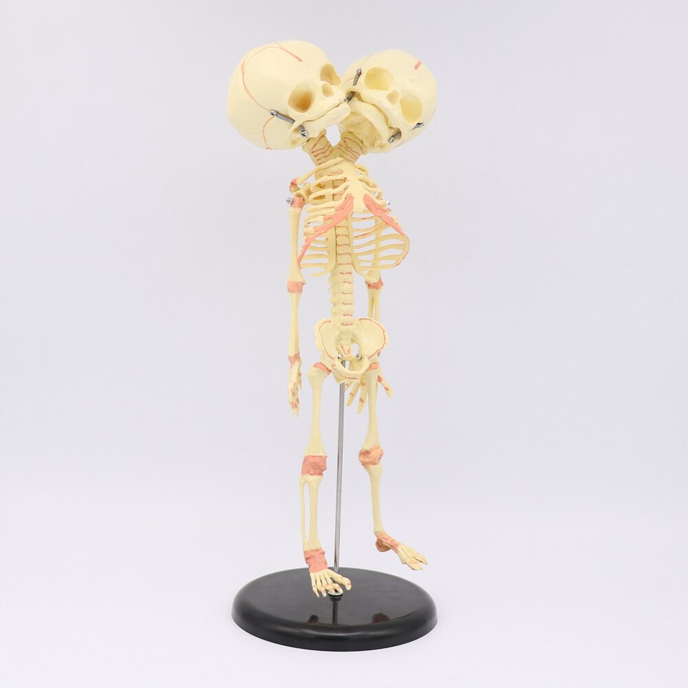 35CM crâne à deux têtes humain -né bébé Double tête anatomie crâne squelette anatomique éducation cérébrale modèle d'étude anatomique