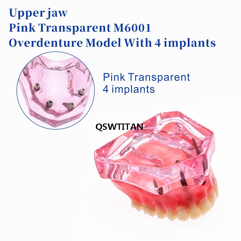 Sobredentadura Dental Superior con 4 implantes, modelo de demostración, enseñanza Dental, estudio, modelo de dientes
