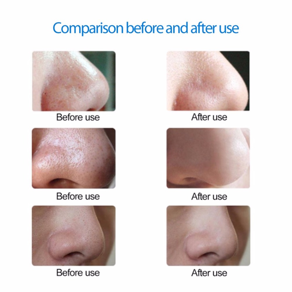Electric Blackhead Vacuum Suction Facial Pore Spot Cleaner Face Dirt Suck Up Vacuum Acne Pimple Remover Beauty Skin Care Tool