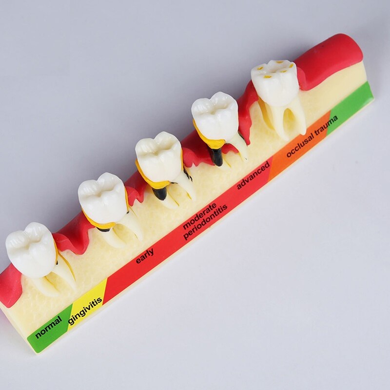 thumbnail interactive-video image 1 of Dental Teeth Model - Caries & Periodontal Disease Demonstration For Teaching 1 of 6
