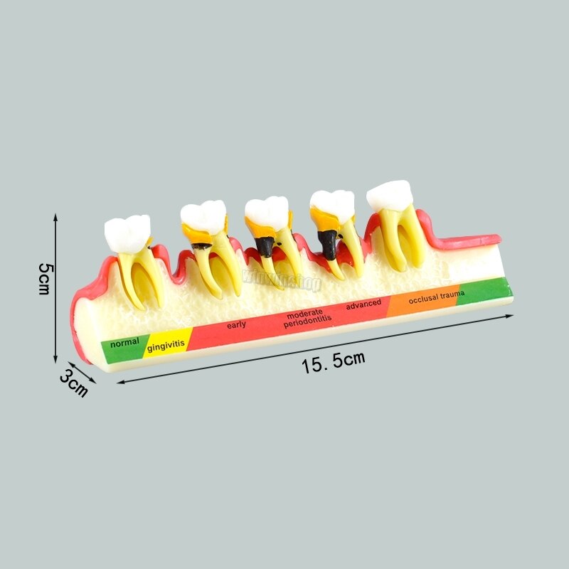 Dental Periodontal Disease Classification Model Demonstration Teach Study Decayed tooth Show Periodontal Disease Progress Model