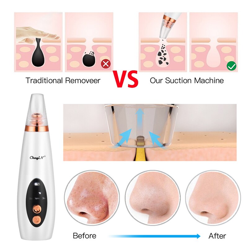 EMS Facial Mesotherapy RF EMS Red Blue LED Photon Face Lifting Tighten Wrinkle Removal Anti Aging+Black Spots Pore Cleaner
