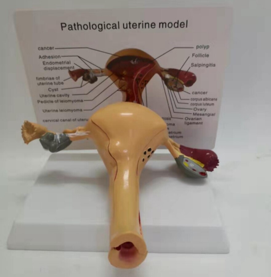 Female pathological uterus model Advanced simulation pathological uterus model of structure anatomy of gynecology and obstetrics