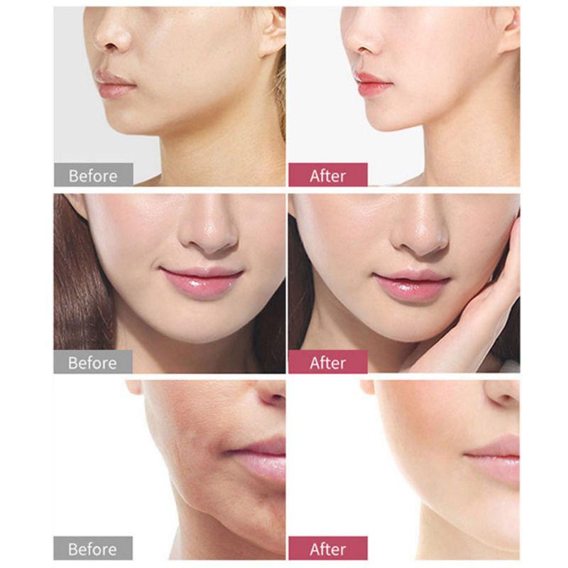 masajeador de doble mentón con instrumento de elevación facial en V para eliminar la barbilla Color piel ligera