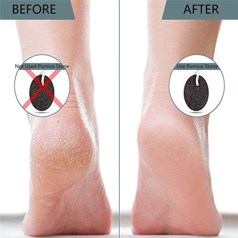 Pumice 2 Pack Natural Earth Lava Stone Pedicure Kit Tool Hard Skin Callus Remover for Feet and Hands Warts Corn Removal