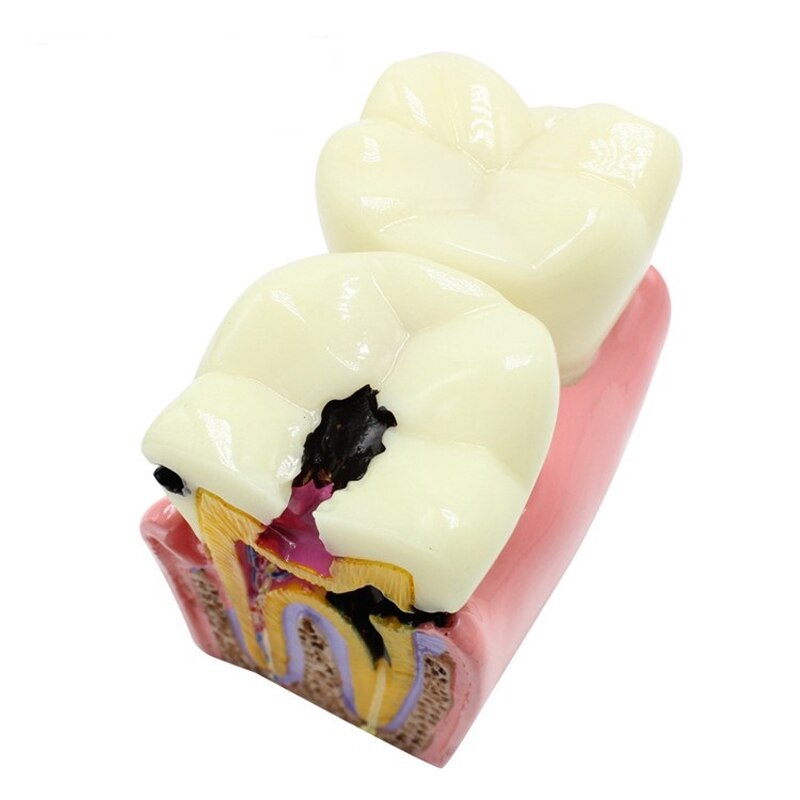 6Ttimes Cariës Comparation Tanden Model M4021 Tonen Normale Anatomische Oppervlak Van De Tand/Dental Onderwijs Model M4021