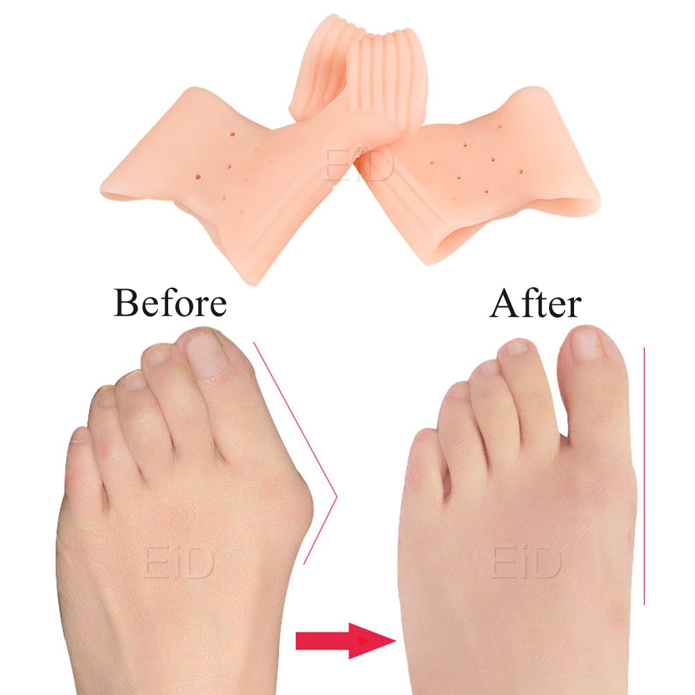 Eid hallux valgus ortose silikone tåseparator knystpuder korrektionsspreder fodbeskytter finger smertelindrende indlæg