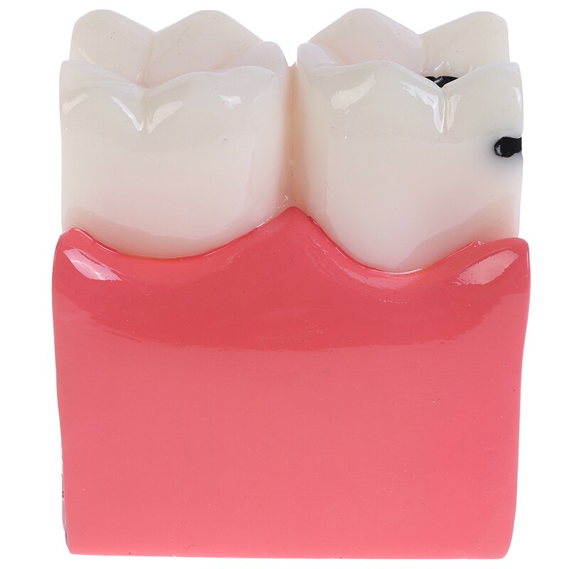 Dental Teeth Model 6 Times Caries Comparation Study Denture Tooth Models