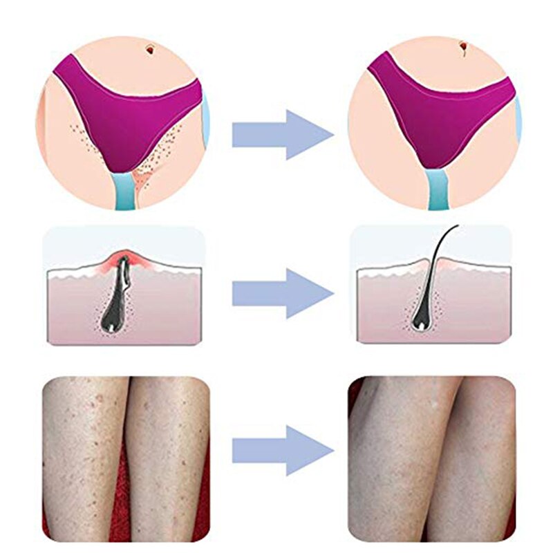 Exfoliërende Borstel Body Borstel Elimineren Scheren Irritatie Voor Gezicht Hals Oksel Bikini Lijn Benen Voorkomen Scheermes Stoten Haar Massage