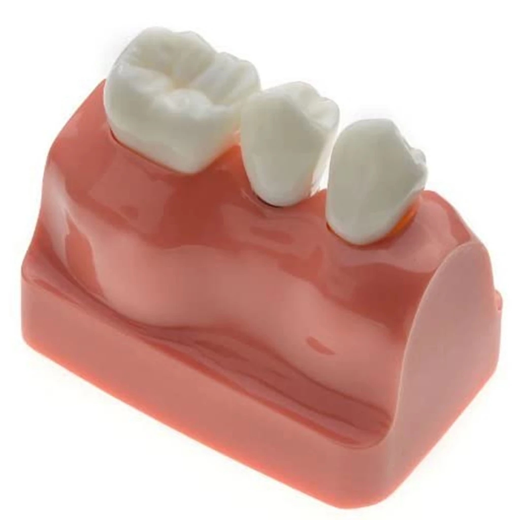 1Pcs Dental Tooth Implant Removable Model Crown Abutment Dentistry Laboratory Educational Materials Dentist Study Dentures M2017