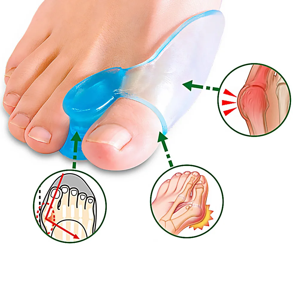 1 paar Siliconen Teen Separator Siliconen Gel Duim Corrector Bunion Kleine Teen Protector Hallux Valgus Voetverzorging Relief Pads