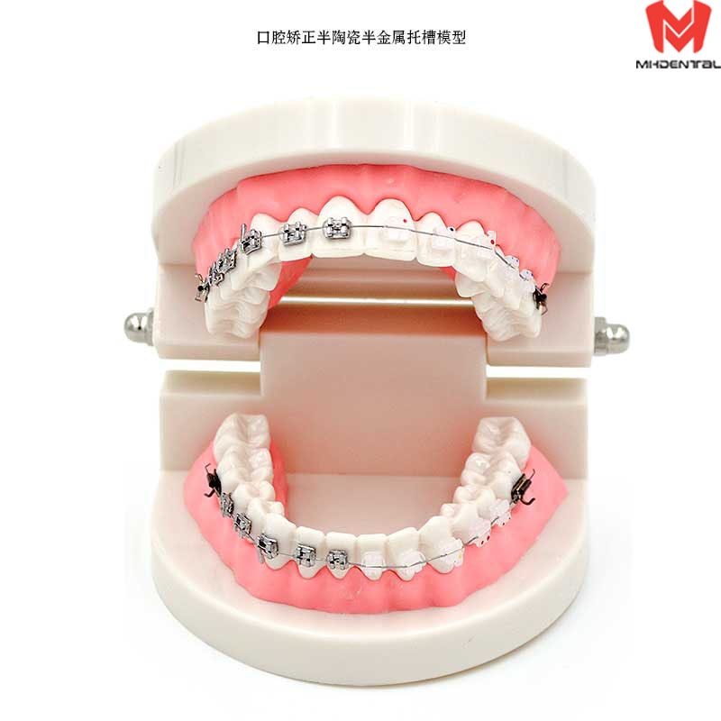 Tandheelkundige Model Van Tanden Met Half Metalen En Keramische Beugel Tandarts Tandheelkunde Materialen Directe Verkoop Fabriek