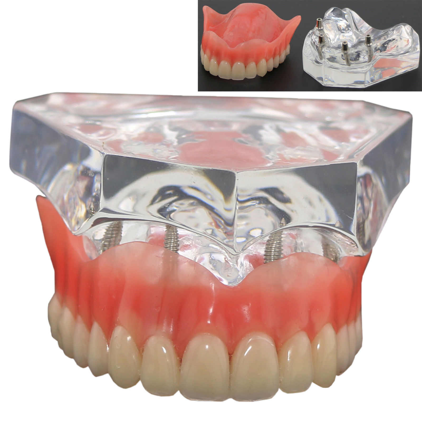 1 Stks/pak Dental Bovenste Overkappingsprothese Superieure 4 Implantaten Demo Model 6001 02 Tanden Model