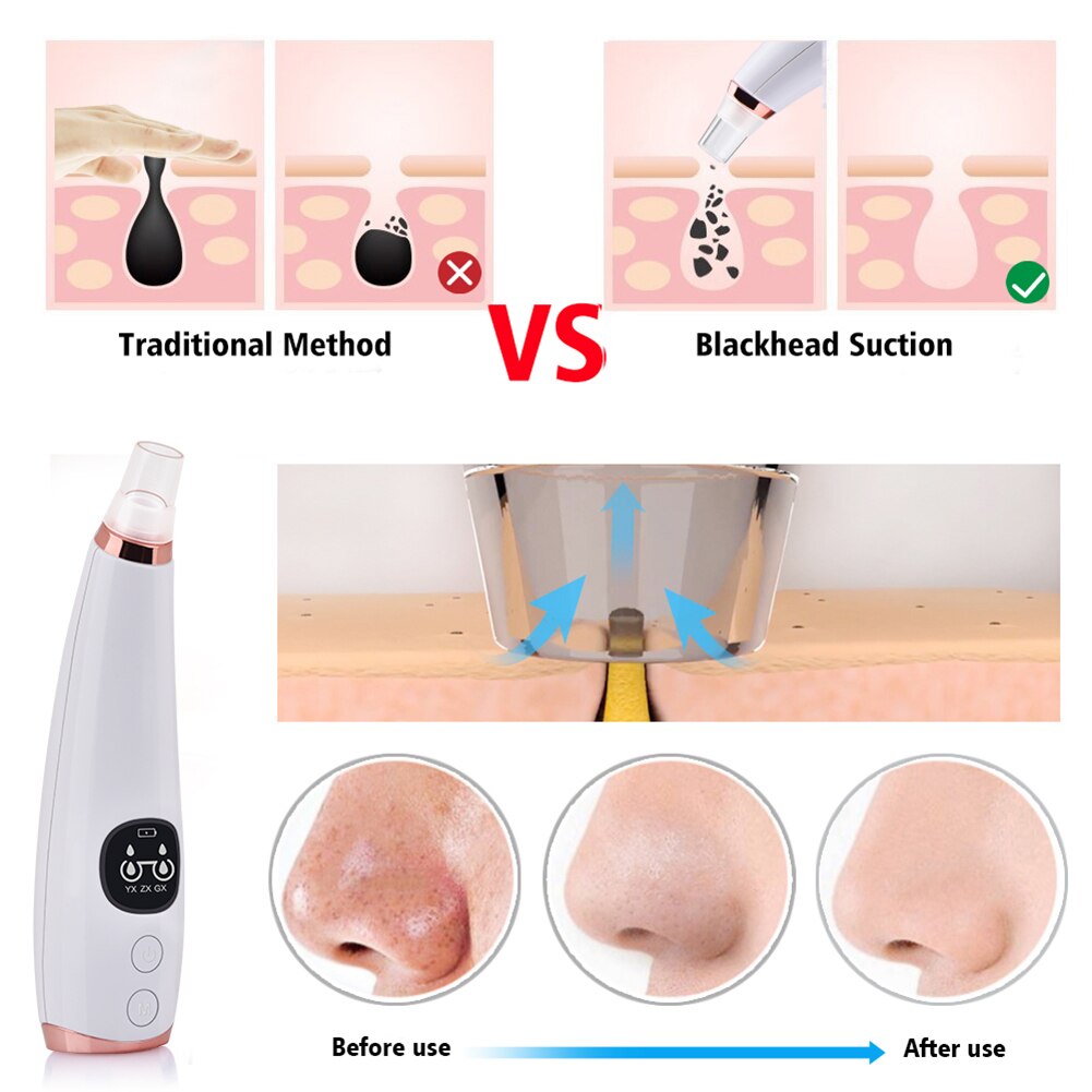 Electric Acne Remover Point Noir Blackhead Vacuum Extractor Tool Black Spots Pore Cleaner Skin Care Facial Pore Cleaner Machine