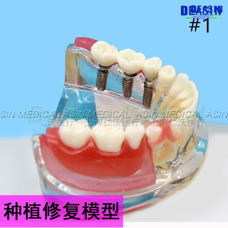 1 pc x Resin Coverage dental implant model dentures Removable teeth model for dentist study Deasin