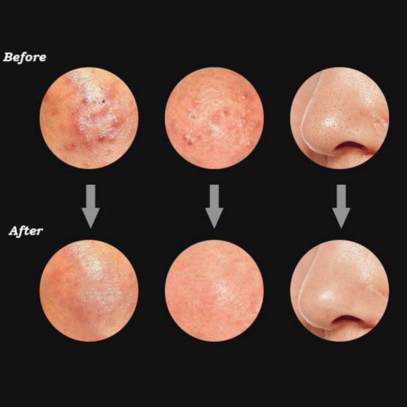 Tools Kit Acne Extractor Remover Blackhead Pimple Needles Blemish Treatments Set Makeup Tool Kits