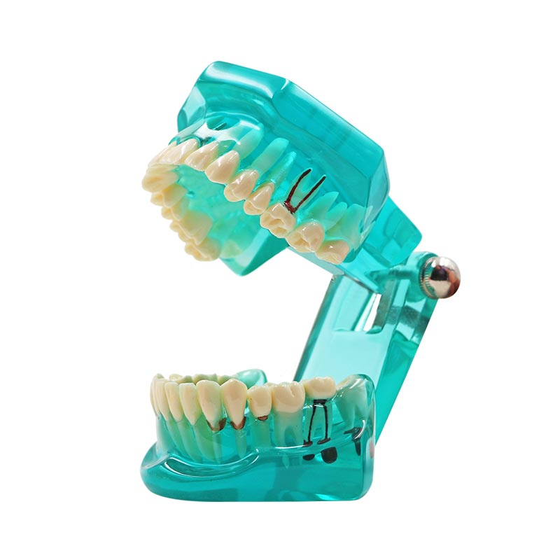 Modèle de dent multicolore, 1 pièce, modèle Standard d&#39;enseignement et d&#39;apprentissage dentaire pour adultes, utilisé dans les cliniques de stomatologie et de recherche