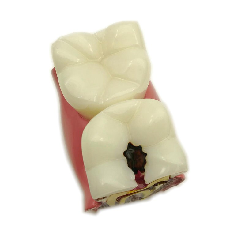 1pc Dental Anatomy Education Teeth Model 6 Times Caries Comparation Study Models For Dentist Studying and Researching