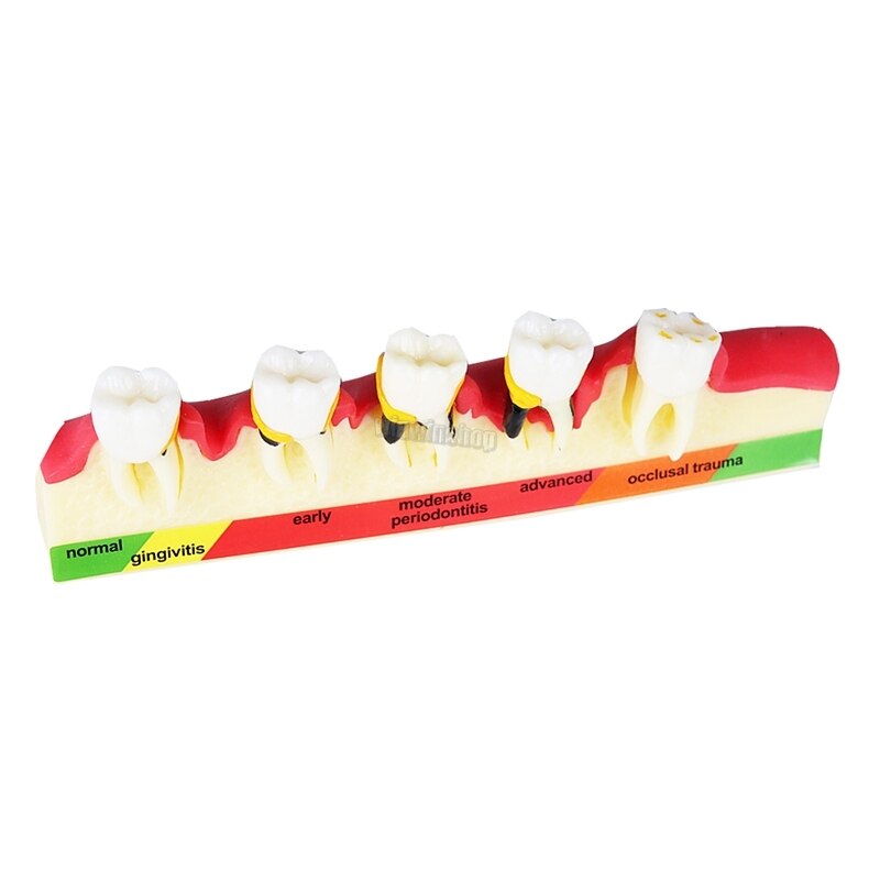 Dental Periodontal Disease Classification Model Demonstration Teach Study Decayed tooth Show Periodontal Disease Progress Model