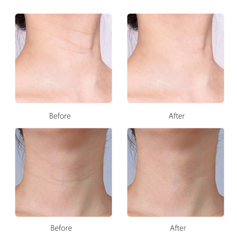 3 Kleuren Led Neck Anti Rimpel Facial Lifting Schoonheid Apparaat Micro Huidige Iontoforese Verminder Dubbele Kin Rimpel Beauty Tools
