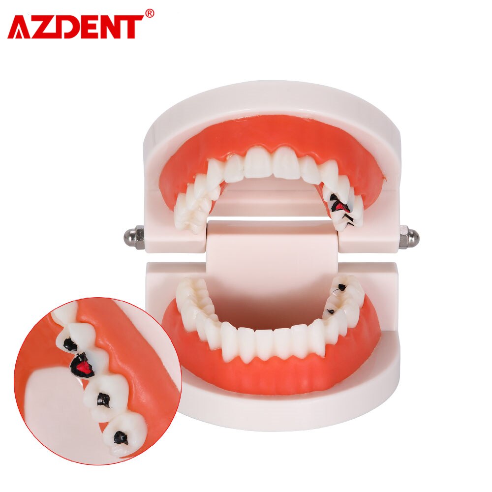 Dental Teeth Model Tooth Decay Model PVC School Teaching Equipment