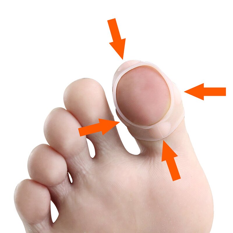 1 paar hallux valgus teenspreiders voetverzorgingstool silone stof hallux valgus correctie