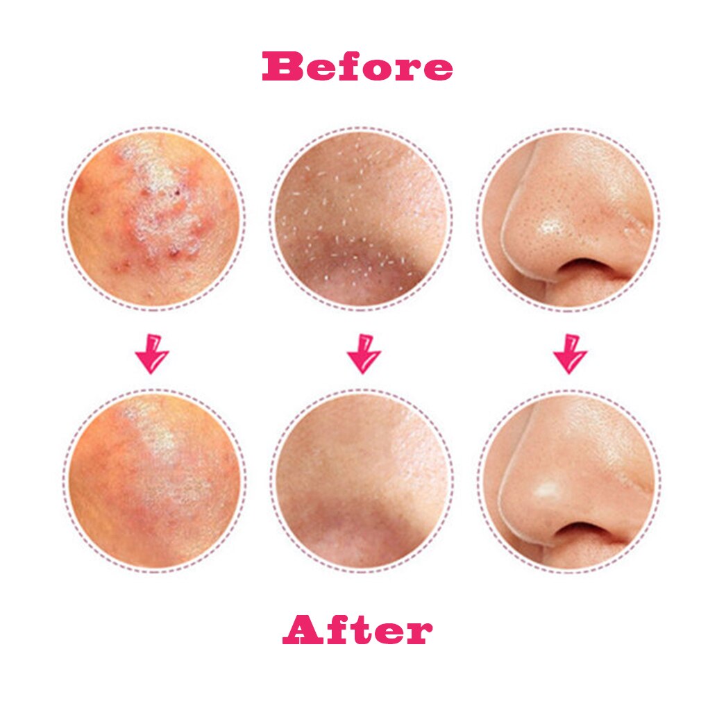 Útil gancho para acné y puntos negros curvado y recto de acero inoxidable pinzas removedor de comedones Kit limpiador facial